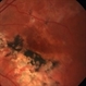 Serpiginous Choroiditis Endstage Serpiginous Choroiditis Endstage